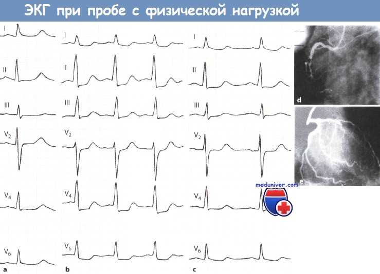 Нагрузочная электрокардиография: уникальный метод диагностики сердечных заболеваний