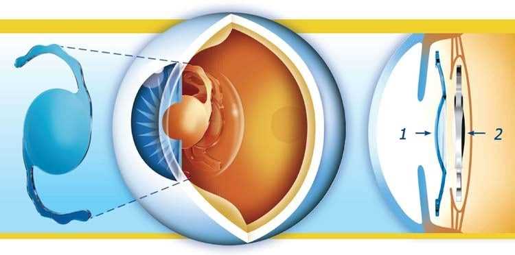 Реабилитация после операции катаракты: важная стадия восстановления зрительного функционирования