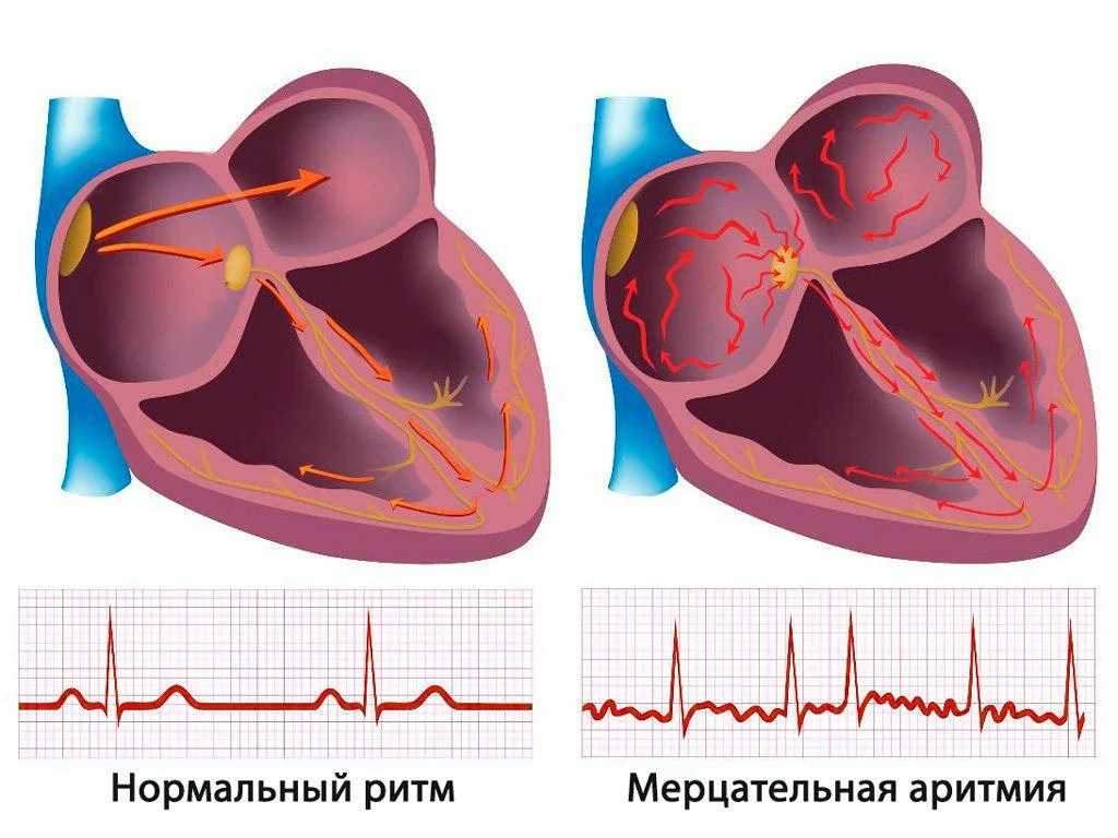 Физическая активность и ее влияние на здоровье сердца при аритмии