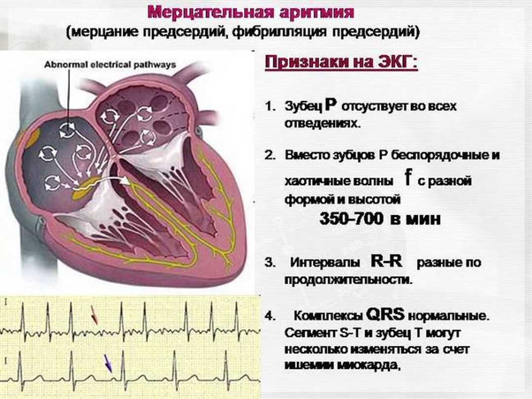 Физические нагрузки при аритмии сердца: возможности и ограничения