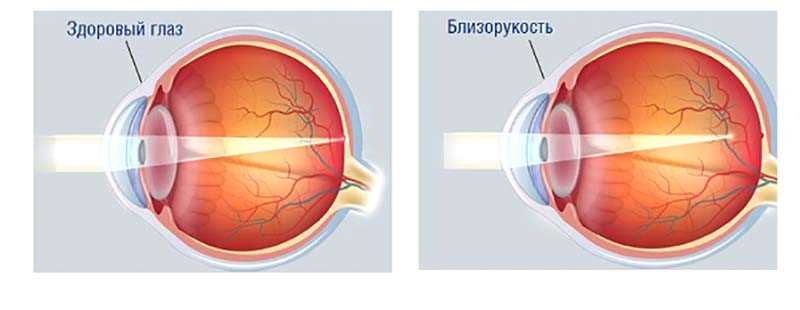 Влияние физической активности на глаза