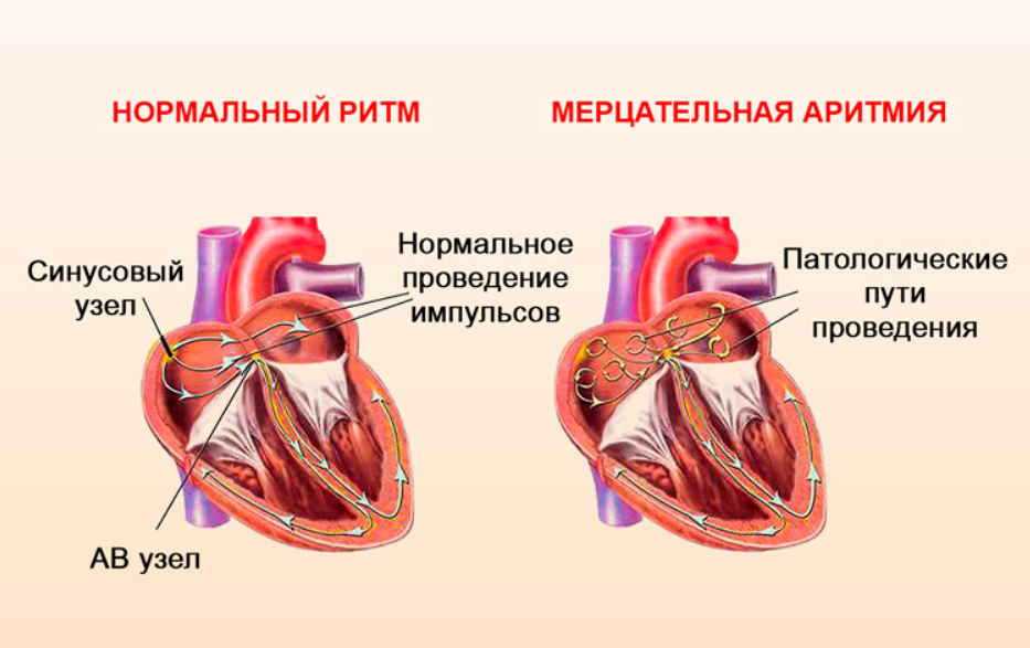Рекомендации по предотвращению перебоев в работе сердца